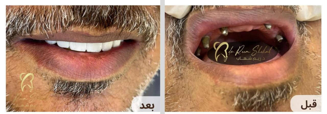 زراعة أسنان للفك العلوي  وعمل تركيب زريكون ثابت والاستغناء عن الطقم المتحرك المزعج ،، وذلك بعد خسارة المريض لجميع أسنانه   استطاع المريض استعادة ثقته بنفسه وقدرته على الأكل بشكل طبيعي  اختيار اللون/ حسب رغبة المريض   من حالات/ دكتورة ريم شهاب