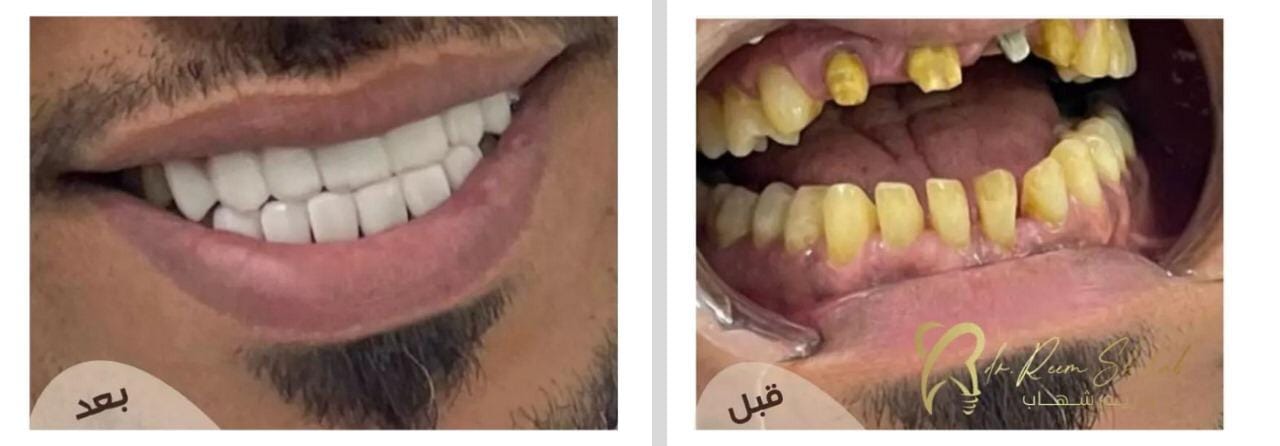 صناعة ابتسامة   شكر خاص لدكاترة التركيبات المساعدين  من حالات / دكتورة ريم شهاب