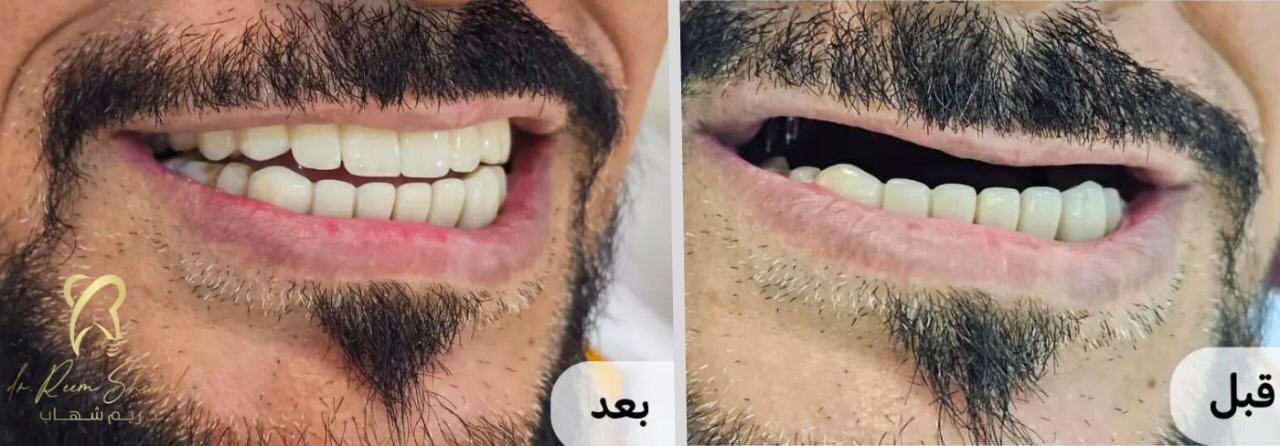 استطاع المريض استعادة ثقته بنفسه وقدرته على الأكل، وذلك بعد عمل (زراعة أسنان للفك العلوي ) وتثبيت عليها أسنان زيريكون جمالية وثابتة من حالات عيادة/ دكتورة ريم شهاب   - عيادات صفوة المهيدب القنفذة  شكر خاص لصانع الابتسامة المبدع الدكتور/ محمود حجاج