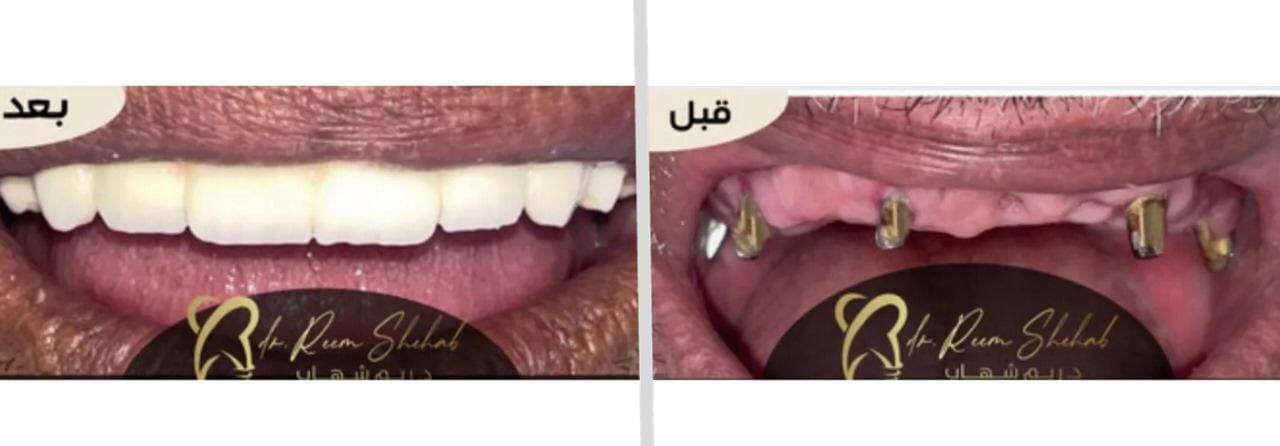 زراعة أسنان للفك العلوي وعمل تركيبات ثابتة عليها ،،  من حالات / دكتورة ريم شهاب