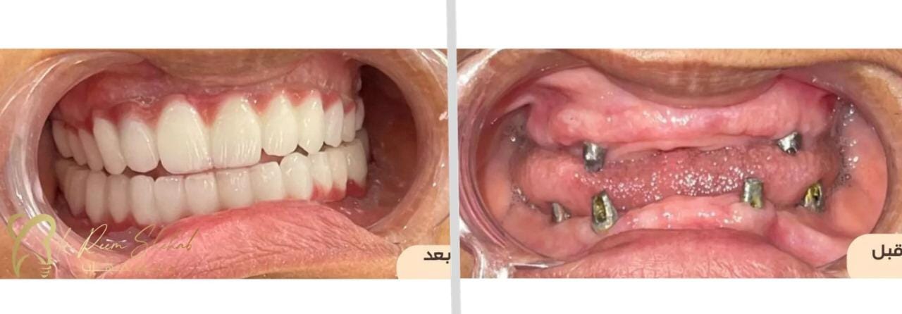 استعادت المريضة الأمل في الابتسامة والقدرة على الأكل بعد فقدان أسنانها بشكل كلي  وذلك بعمل (زراعة أسنان في الفكين) وتركيب عليها اسنان زريكون جمالية وثابتة  من حالات/ دكتورة ريم شهاب