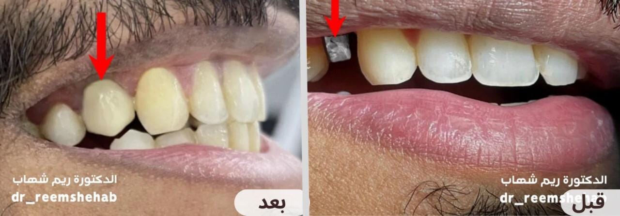 تم تعويض سن مفقود من خلال زراعة الأسنان دون الحاجة لنحت الأسنان الجانبية