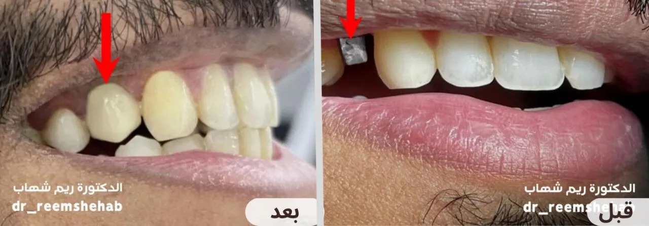 تم تعويض سن مفقود من خلال زراعة الأسنان دون الحاجة لنحت الأسنان الجانبية