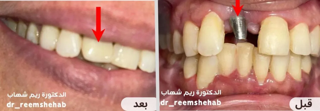 تم عمل زراعة سن واحد بدون الحاجة لنحت الأسنان الجانبية السليمة. من حالات الدكتورة ريم شهاب