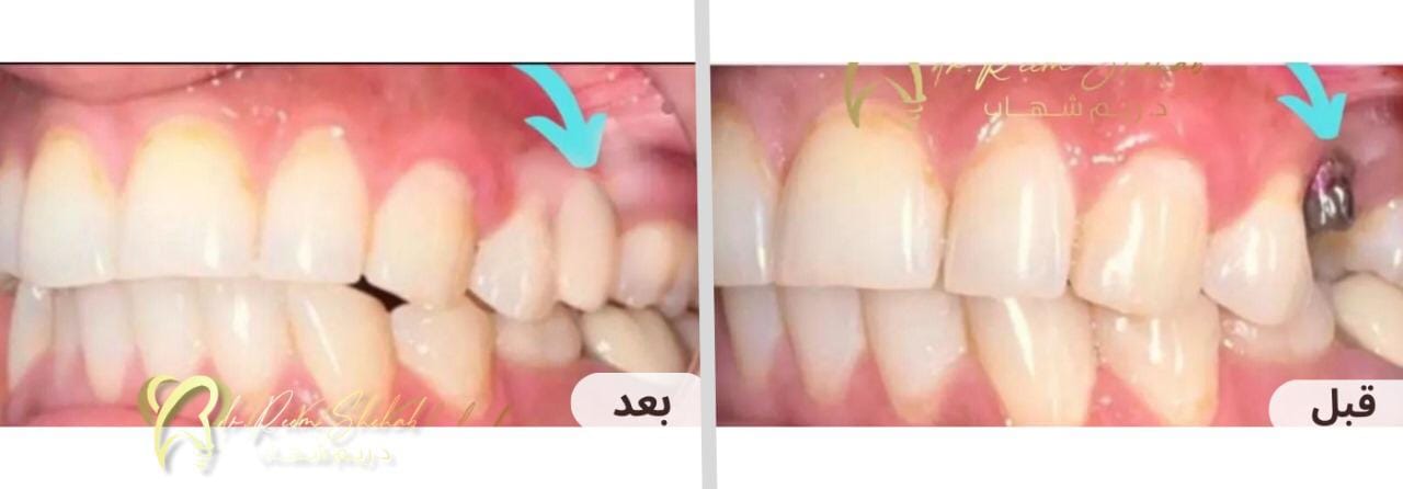 تعويض السن المفقود ب( زرعة أسنان) وتثبيت عليها تركيب زريكون ثابت وأقرب للأسنان الطبيعية ،،  بدون الحاجة لنحت الأسنان الجانبية وبدون عمل جسر تقليدي طويل   من حالات/ دكتورة ريم شهاب