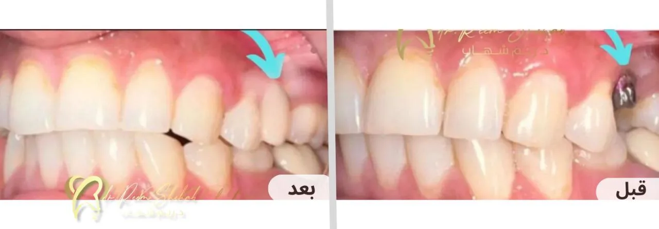 تعويض السن المفقود ب( زرعة أسنان) وتثبيت عليها تركيب زريكون ثابت وأقرب للأسنان الطبيعية ،، بدون الحاجة لنحت الأسنان الجانبية وبدون عمل جسر تقليدي طويل من حالات/ دكتورة ريم شهاب