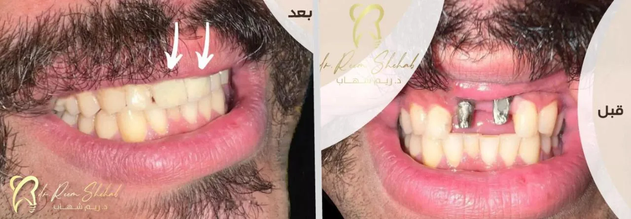 عمل (زرعتين سنية) لتعويض الأسنان المفقودة وتركيب عليها اسنان زريكون ثابتة ولونها أقرب للطبيعي ،، بدون الحاجة لعمل جسر تقليدي طويل وبدون نحت الأسنان الجانبية من حالات/ دكتورة ريم شهاب