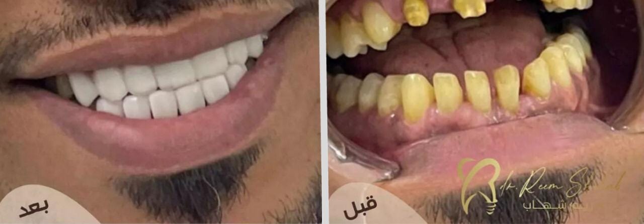 صناعة ابتسامة   شكر خاص لدكاترة التركيبات المساعدين  من حالات / دكتورة ريم شهاب