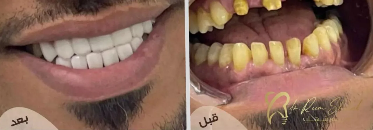 صناعة ابتسامة شكر خاص لدكاترة التركيبات المساعدين من حالات / دكتورة ريم شهاب